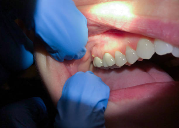 Best Emergency Treatment for Dental Infections or Abscesses in Tangerine, FL